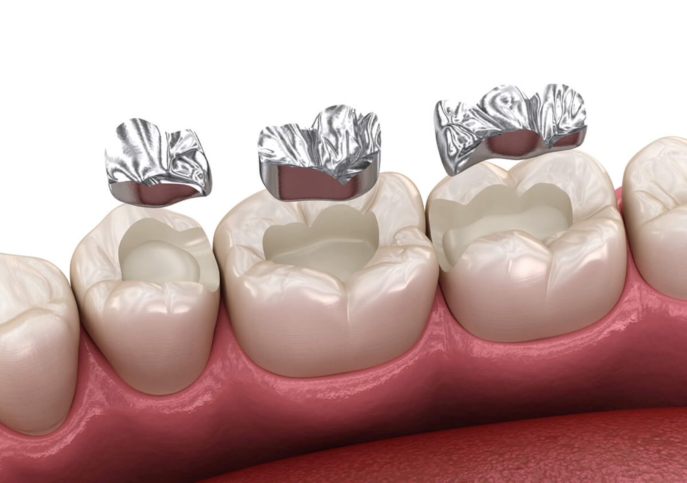 composite dental fillings near you